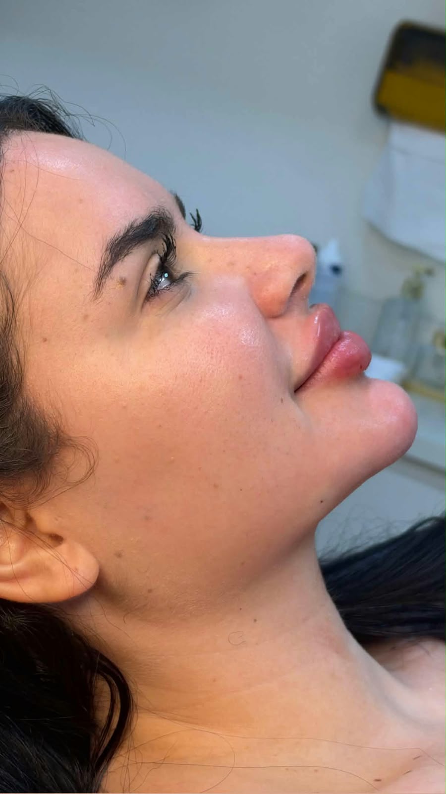 Registro clínico de perfil facial, antes e depois