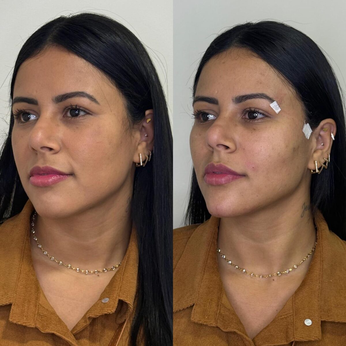 Registro clínico de rejuvenescimento facial, antes e depois
