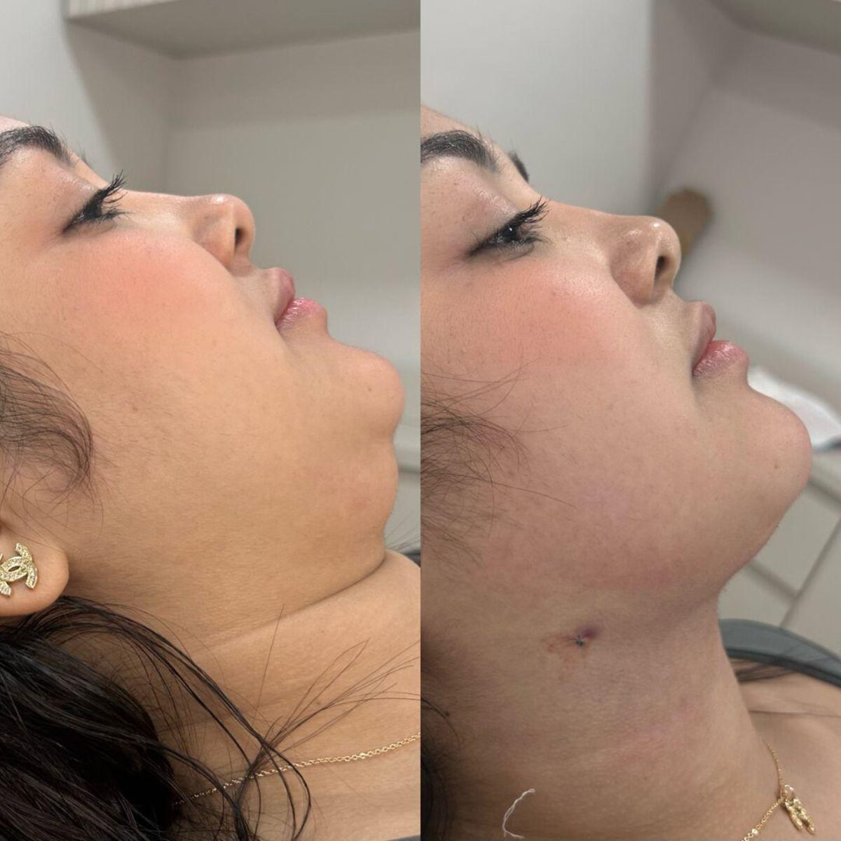 Registro clínico de contorno cervicofacial, antes e depois
